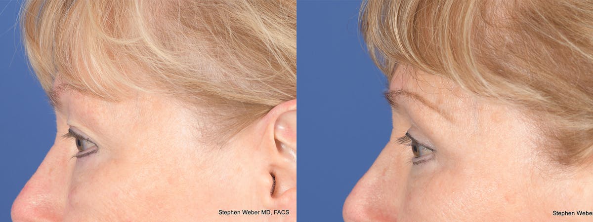 Blepharoplasty Before & After Gallery - Patient 521217 - Image 2