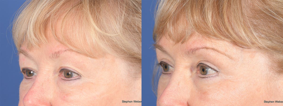 Blepharoplasty Before & After Gallery - Patient 521217 - Image 3