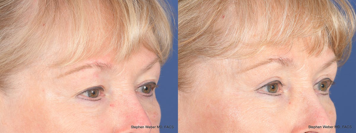 Blepharoplasty Before & After Gallery - Patient 521217 - Image 4