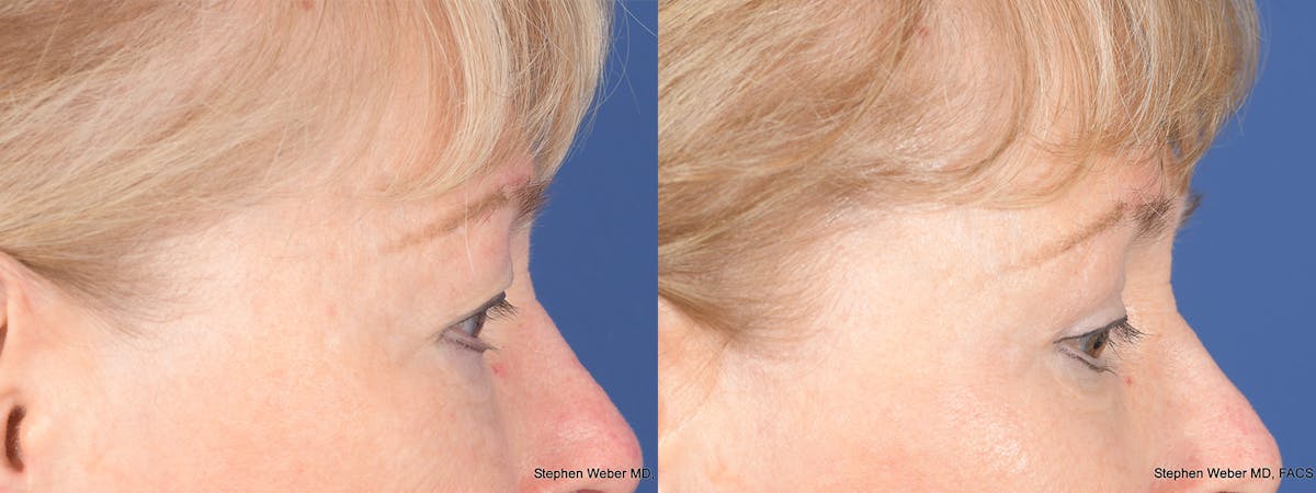 Blepharoplasty Before & After Gallery - Patient 521217 - Image 5