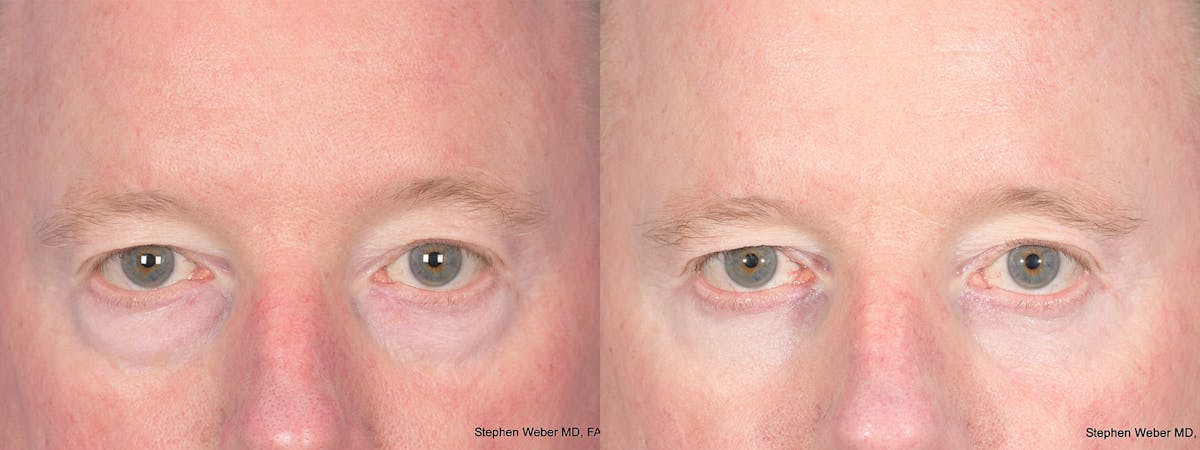 Blepharoplasty Before & After Gallery - Patient 397739 - Image 1