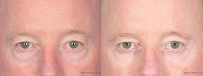 Blepharoplasty Before & After Gallery - Patient 397739 - Image 1