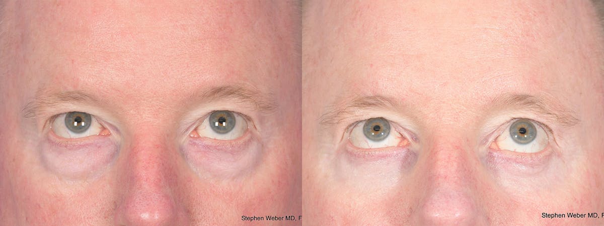 Blepharoplasty Before & After Gallery - Patient 397739 - Image 2