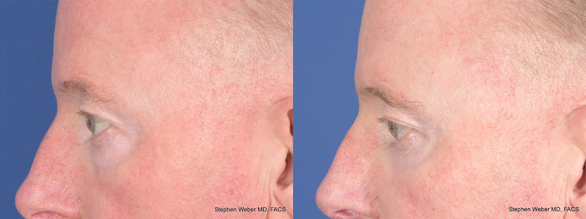 Blepharoplasty Before & After Gallery - Patient 397739 - Image 3