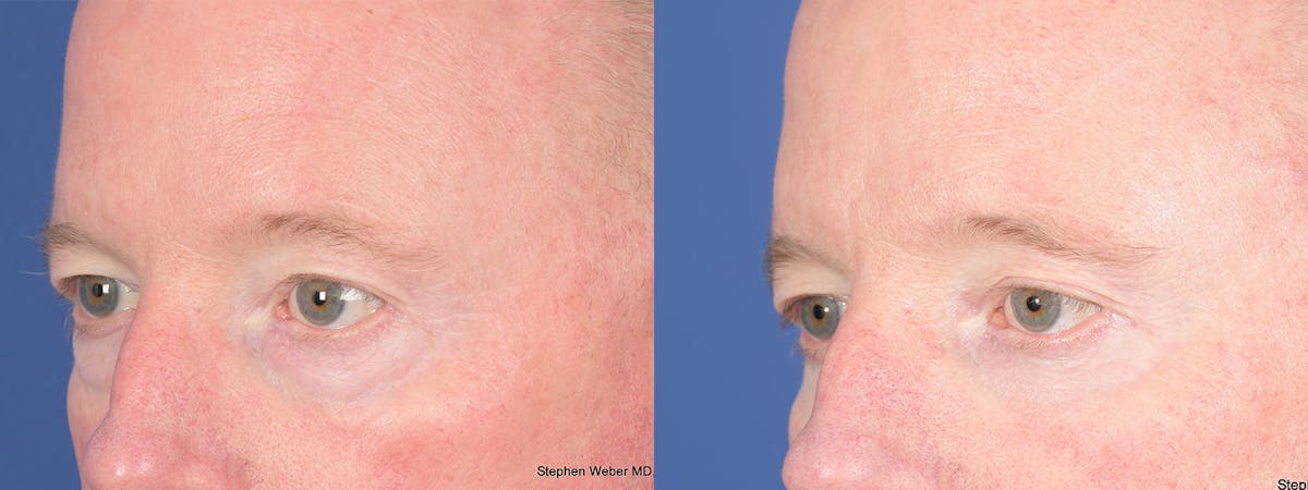Blepharoplasty Before & After Gallery - Patient 397739 - Image 4