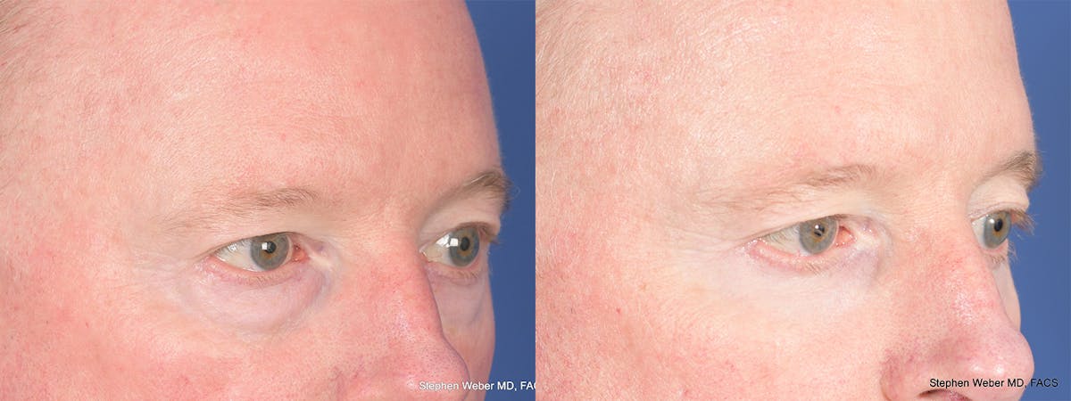 Blepharoplasty Before & After Gallery - Patient 397739 - Image 5