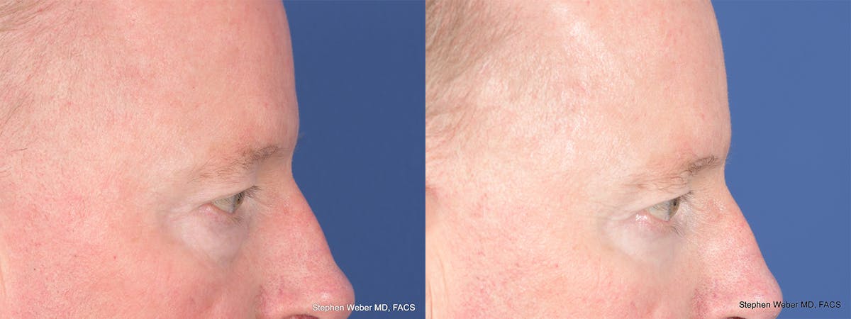 Blepharoplasty Before & After Gallery - Patient 397739 - Image 6