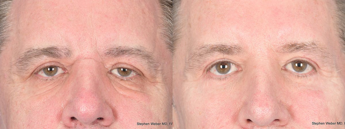 Blepharoplasty Before & After Gallery - Patient 365449 - Image 1