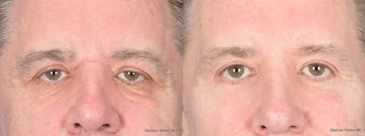 Blepharoplasty Before & After Gallery - Patient 365449 - Image 1