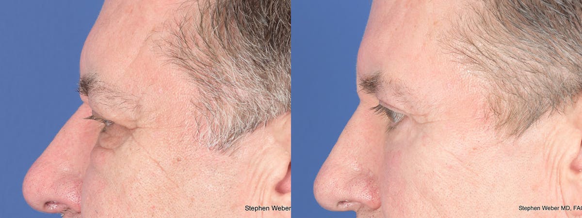 Blepharoplasty Before & After Gallery - Patient 365449 - Image 2
