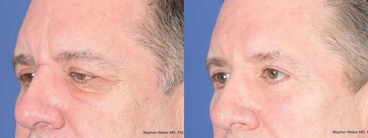 Blepharoplasty Before & After Gallery - Patient 365449 - Image 3
