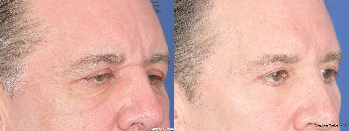 Blepharoplasty Before & After Gallery - Patient 365449 - Image 4