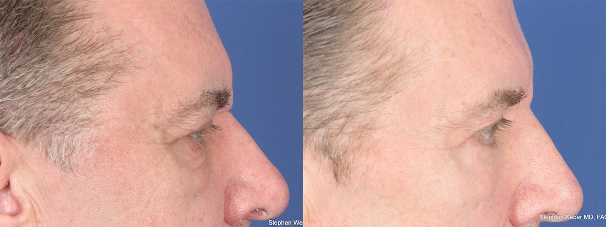 Blepharoplasty Before & After Gallery - Patient 365449 - Image 5