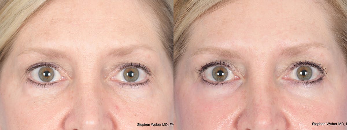 Blepharoplasty Before & After Gallery - Patient 393206 - Image 1