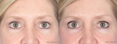 Blepharoplasty Before & After Gallery - Patient 393206 - Image 1