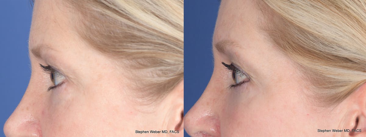 Blepharoplasty Before & After Gallery - Patient 393206 - Image 2
