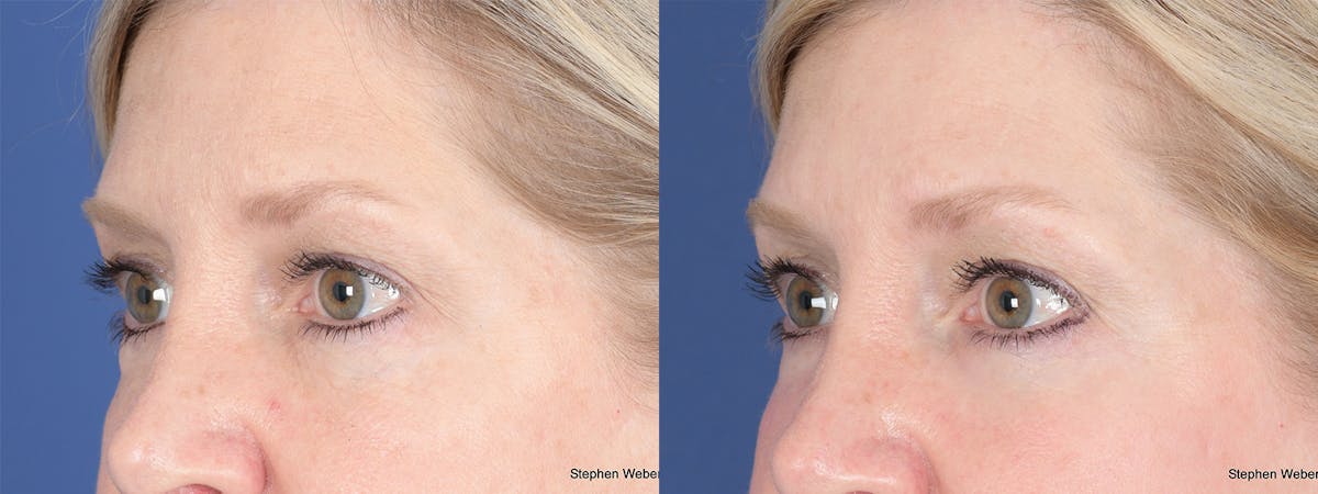 Blepharoplasty Before & After Gallery - Patient 393206 - Image 3