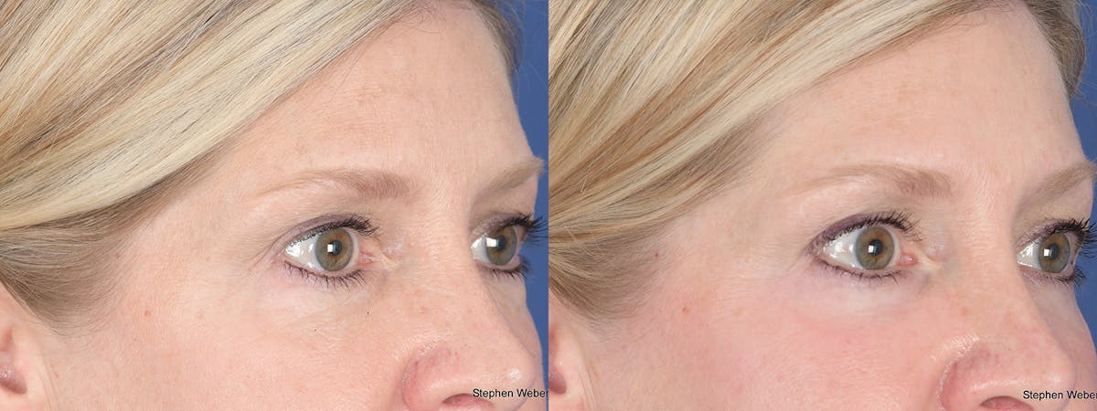 Blepharoplasty Before & After Gallery - Patient 393206 - Image 4
