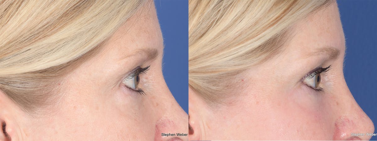 Blepharoplasty Before & After Gallery - Patient 393206 - Image 5