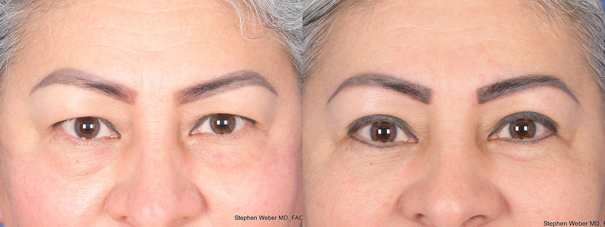 Blepharoplasty Before & After Gallery - Patient 206846 - Image 1