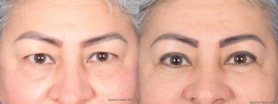 Blepharoplasty Before & After Gallery - Patient 206846 - Image 1