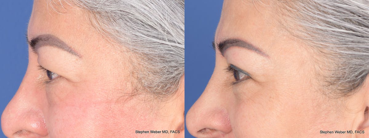 Blepharoplasty Before & After Gallery - Patient 206846 - Image 2