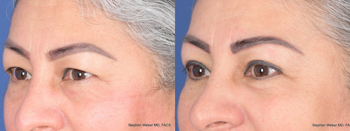 Blepharoplasty Before & After Gallery - Patient 206846 - Image 3