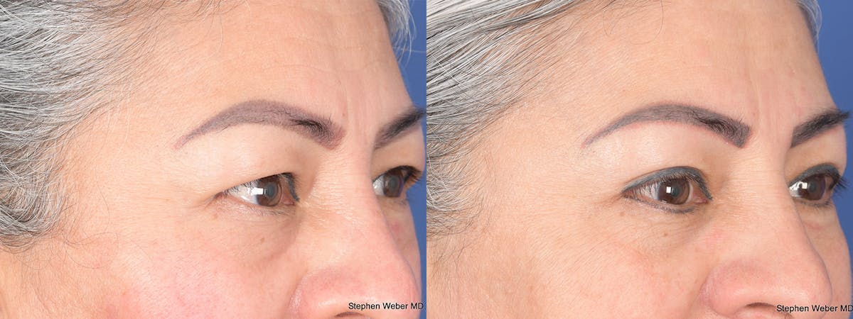 Blepharoplasty Before & After Gallery - Patient 206846 - Image 4