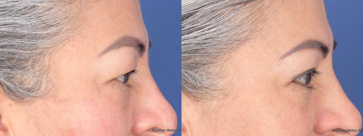 Blepharoplasty Before & After Gallery - Patient 206846 - Image 5