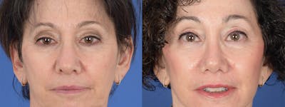 Blepharoplasty Before & After Gallery - Patient 289006 - Image 1