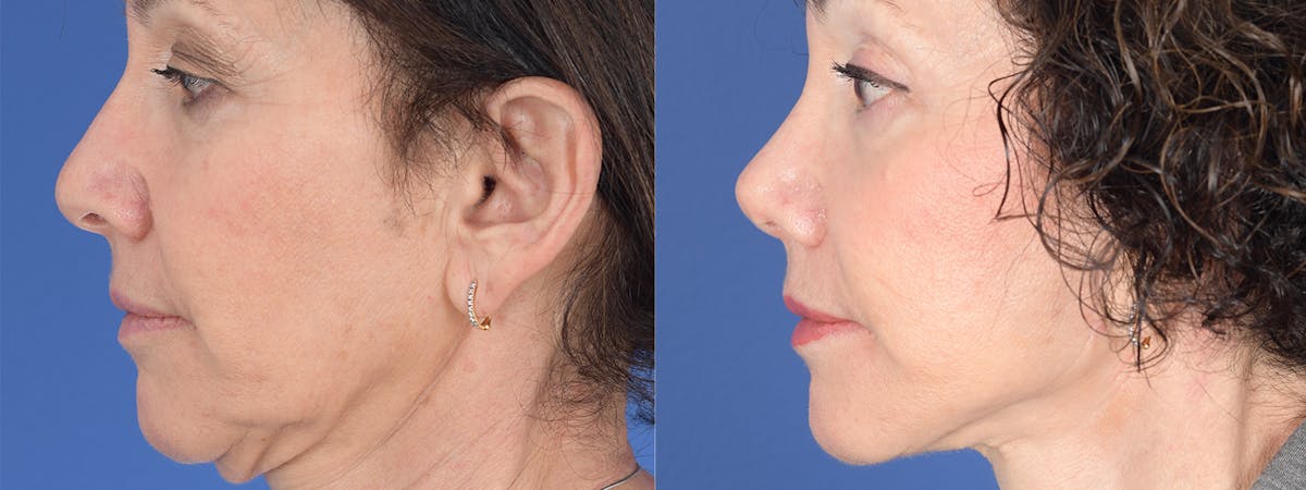 Blepharoplasty Before & After Gallery - Patient 289006 - Image 2