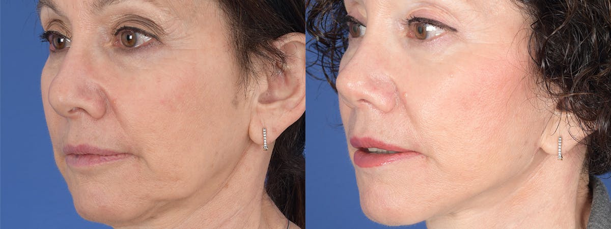 Blepharoplasty Before & After Gallery - Patient 289006 - Image 3