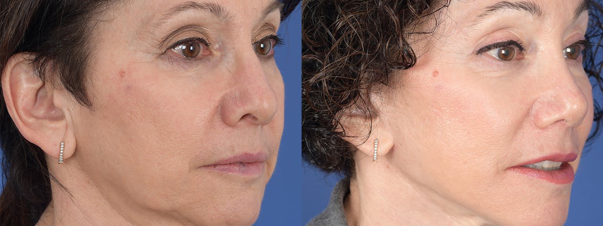 Blepharoplasty Before & After Gallery - Patient 289006 - Image 4