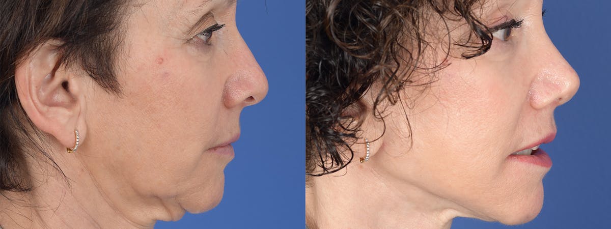 Blepharoplasty Before & After Gallery - Patient 289006 - Image 5