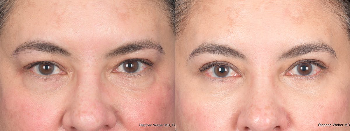 Blepharoplasty Before & After Gallery - Patient 289033 - Image 1