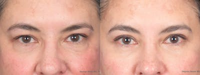 Blepharoplasty Before & After Gallery - Patient 289033 - Image 1