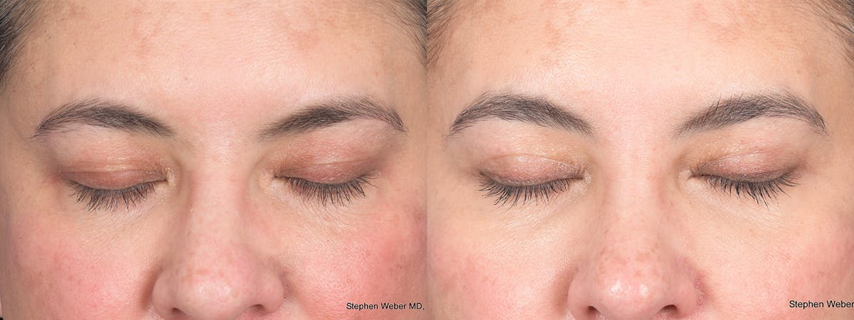 Blepharoplasty Before & After Gallery - Patient 289033 - Image 2