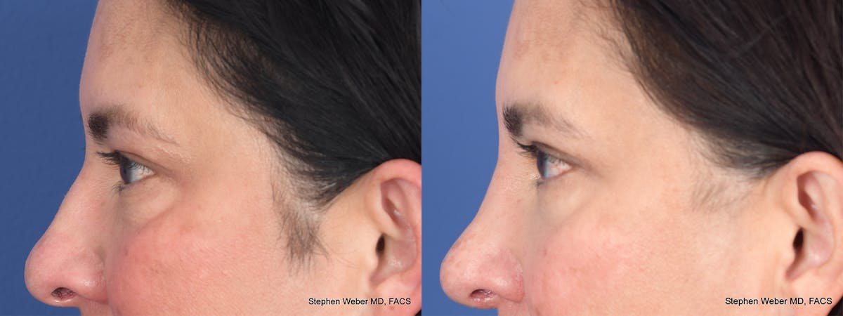 Blepharoplasty Before & After Gallery - Patient 289033 - Image 3