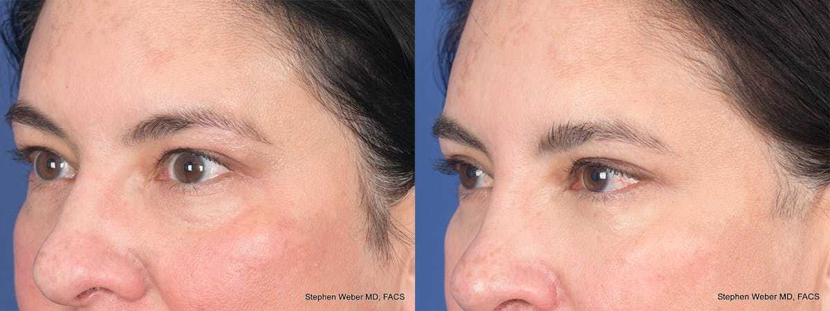 Blepharoplasty Before & After Gallery - Patient 289033 - Image 4