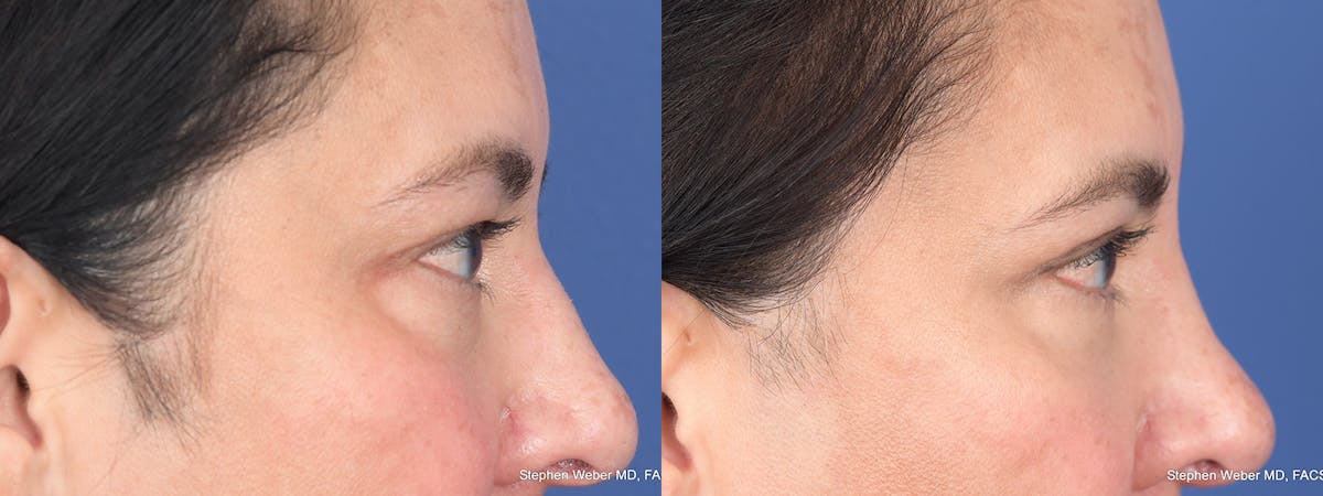 Blepharoplasty Before & After Gallery - Patient 289033 - Image 5