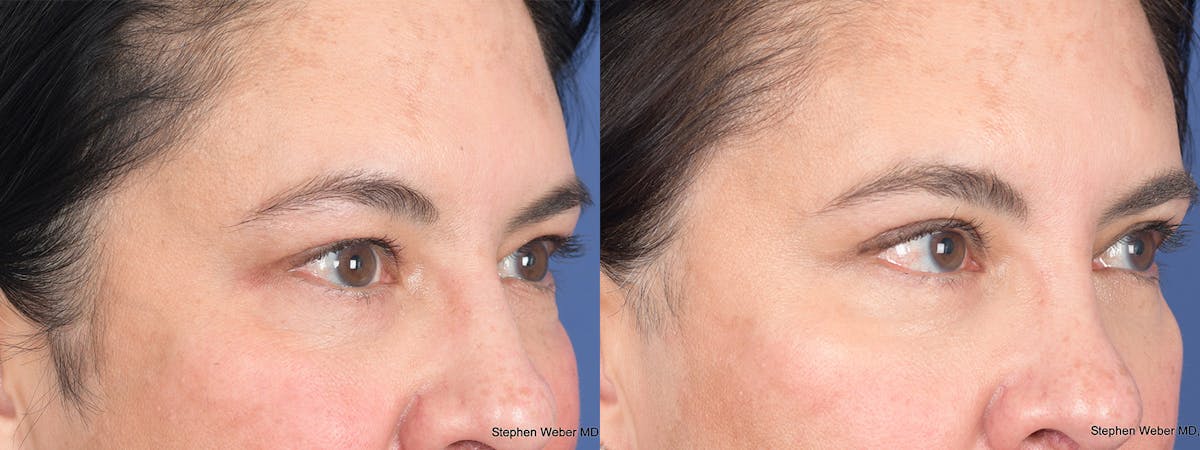 Blepharoplasty Before & After Gallery - Patient 289033 - Image 6