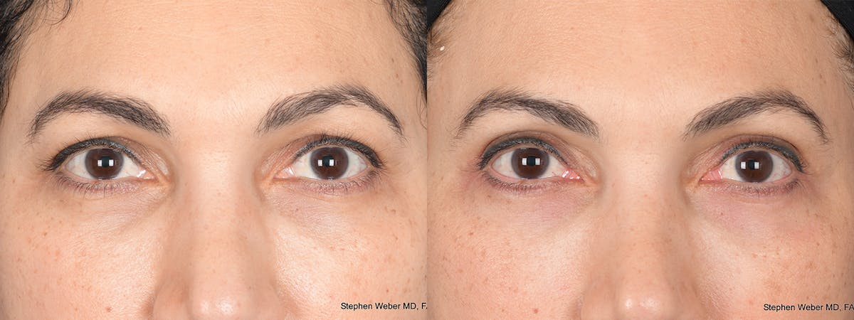 Blepharoplasty Before & After Gallery - Patient 331615 - Image 1