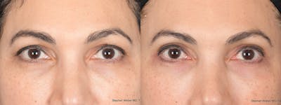 Blepharoplasty Before & After Gallery - Patient 331615 - Image 1