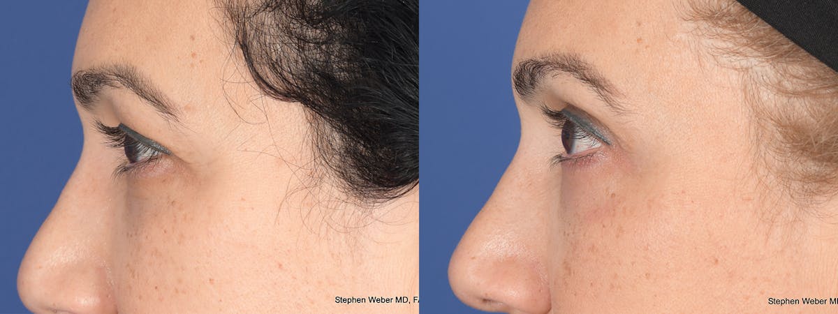 Blepharoplasty Before & After Gallery - Patient 331615 - Image 2