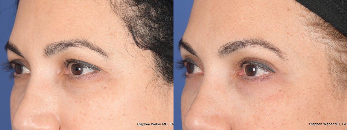 Blepharoplasty Before & After Gallery - Patient 331615 - Image 3