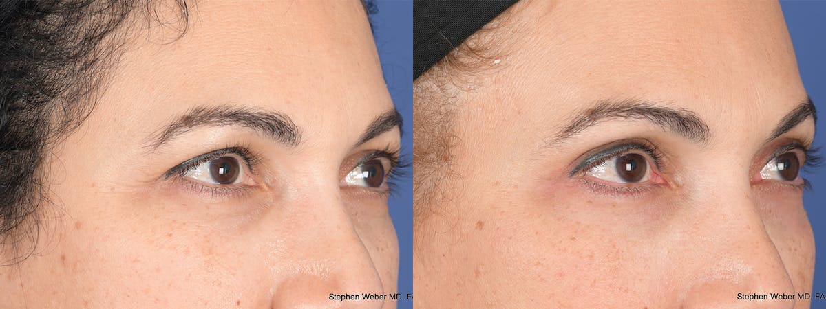 Blepharoplasty Before & After Gallery - Patient 331615 - Image 4