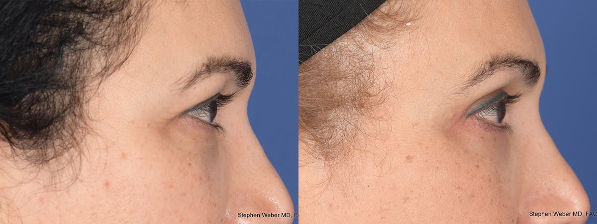 Blepharoplasty Before & After Gallery - Patient 331615 - Image 5