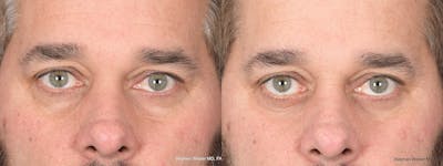 Blepharoplasty Before & After Gallery - Patient 381812 - Image 1