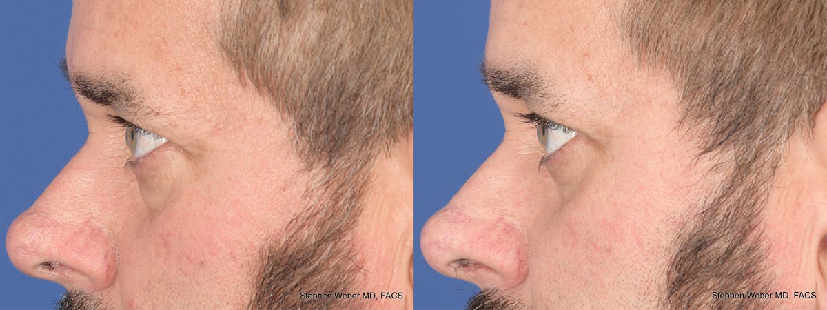 Blepharoplasty Before & After Gallery - Patient 381812 - Image 2