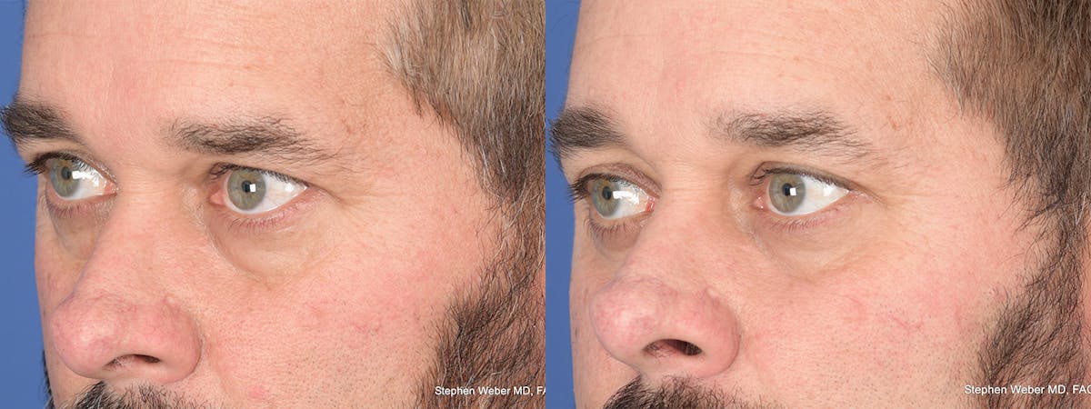 Blepharoplasty Before & After Gallery - Patient 381812 - Image 3
